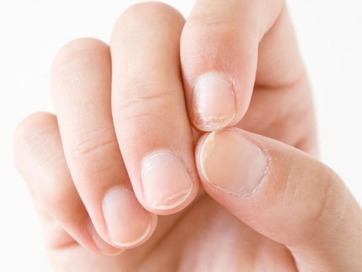 3 Home Remedies For Damaged Nails